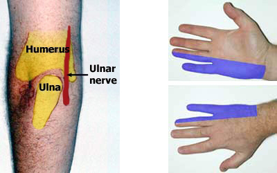 nerveentrapment