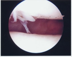 Frayed Cartilage